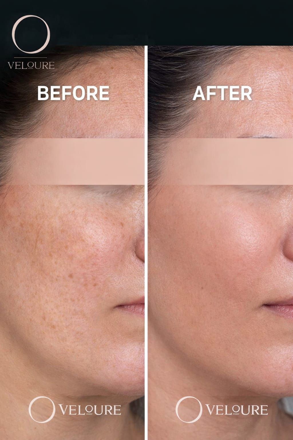 Intense Pigment Removal Duo