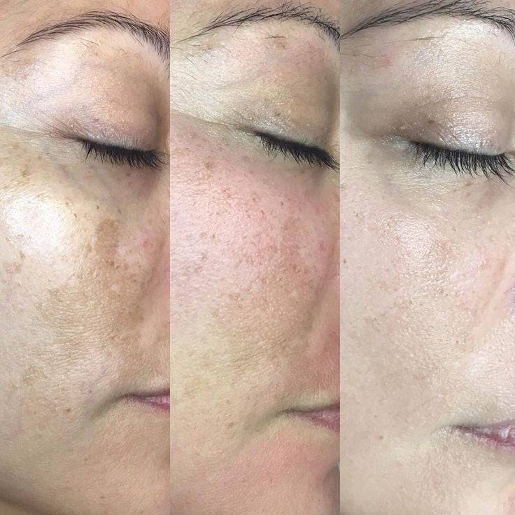 Intense Pigment Removal Duo